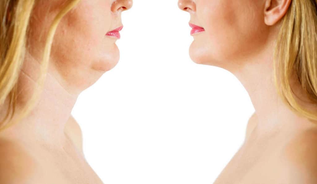 Double Chin treatment Eaton before and after results