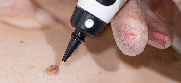 After Skin Tag Removal Eaton