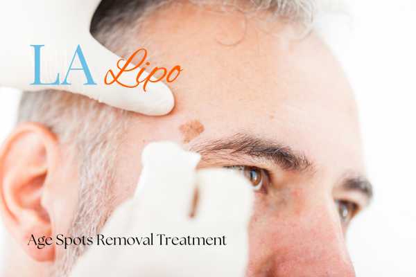 What Are the Most Effective Treatments for Age Spots Eaton?