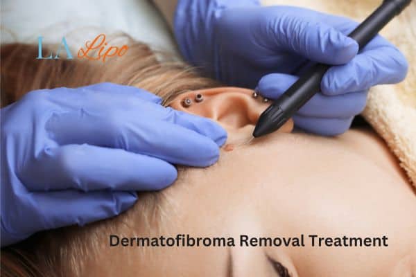 Dermatofibroma Removal Treatment Eaton