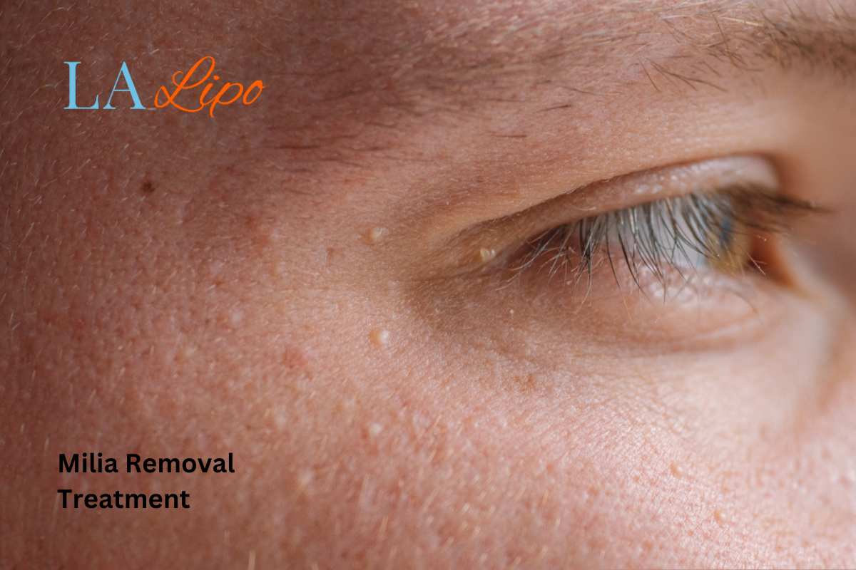 Cryopen Milia Removal: Is It the Easiest and Safest Option Eaton?
