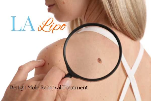 Why getting moles removed Eaton can boost your confidence!