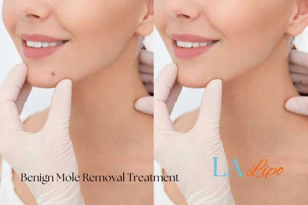 woman's before and after mole removal Eaton results