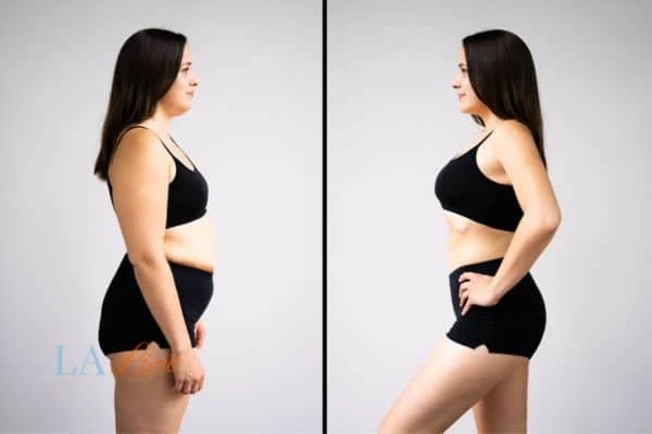 image of woman before and after results of LA-EMS Body Sculpting Eaton to help treat Diastasis recti