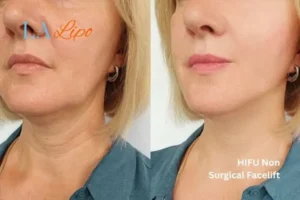 hi-fu for wrinkles Eaton before and after results