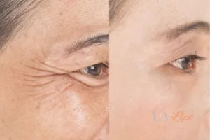 Before and after results of woman - HI-fu wrinkles reduction treatment Eaton