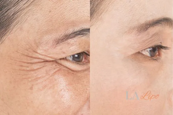 Before and after results of woman - HI-fu wrinkles reduction treatment Eaton