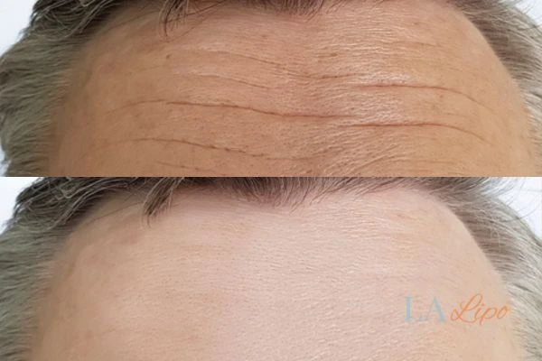 results of HIFU Eaton on mans forehead to help reduce lines and wrinkles