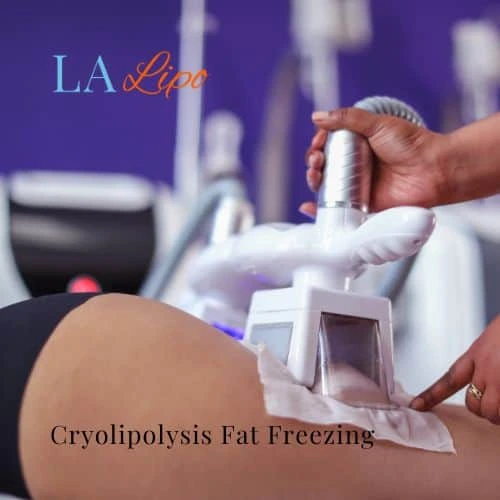 fat freezing - Cryolipolysis Eaton