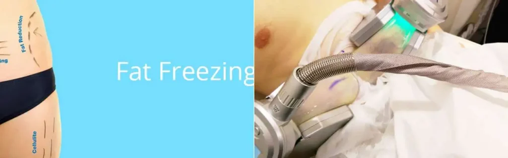 Fat freezing Eaton on multiple areas of the body