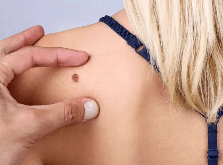 woman having mole removal Eaton consultation before treatment.