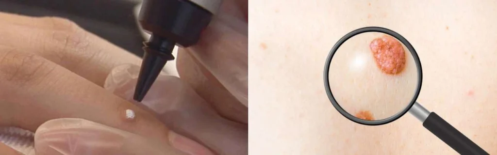Person getting moles removed with cryopen Eaton