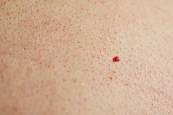 close up of a cherry angioma Eaton