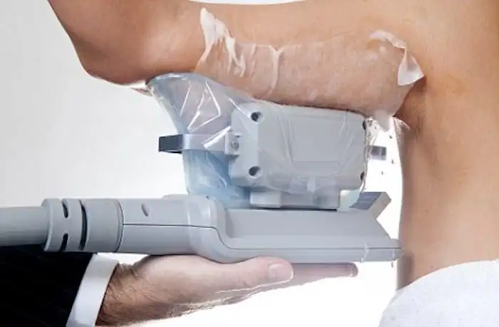 Picture of fat freezing Eaton on the upper arms.