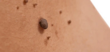 image of a skin tag Eaton