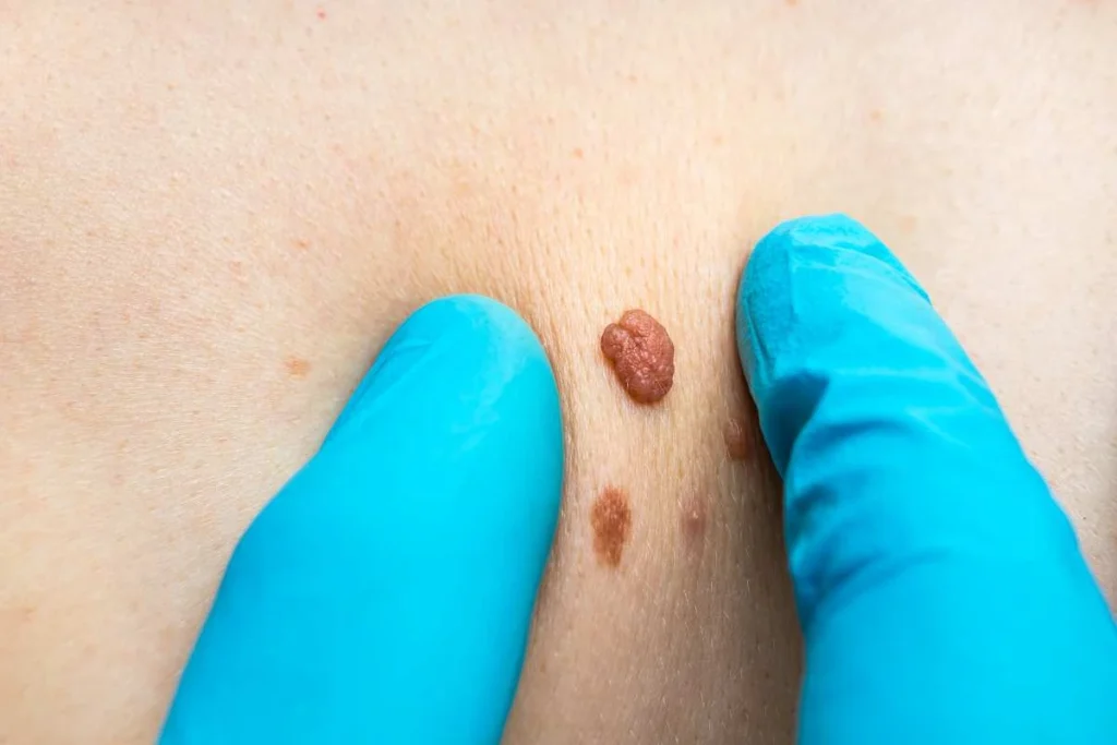 Consultant examining a skin tag Eaton