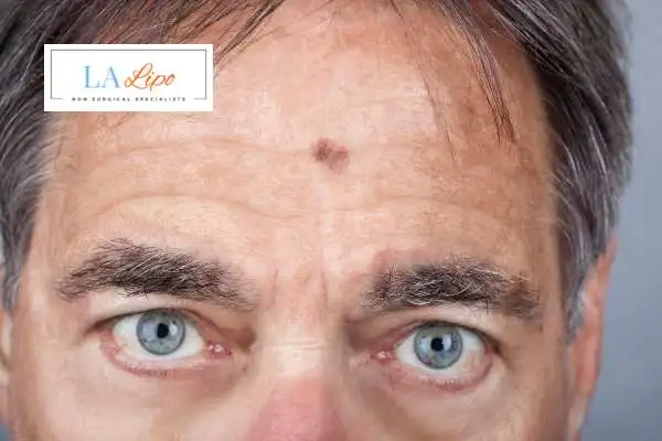 Solar Lentigo Removal Eaton image of man with mark on his forehead