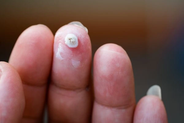 wart on person finger - cryotherapy to treat from LA LIPO Eaton