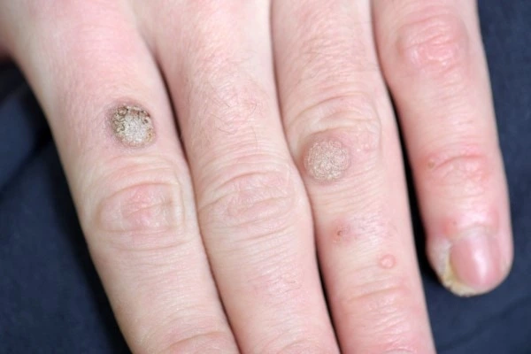 photo of warts on person hand - see wart removal Eaton from LA LIPO