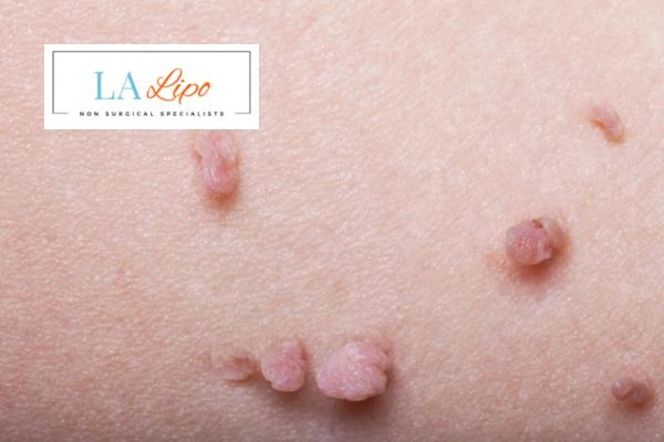 Does cryopen skin tag removal Eaton hurt? Find out now call our team today!