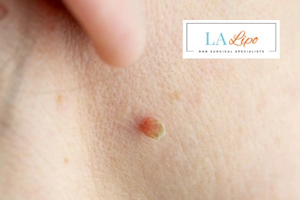 Book skin tag removal Eaton today speak to our team now!