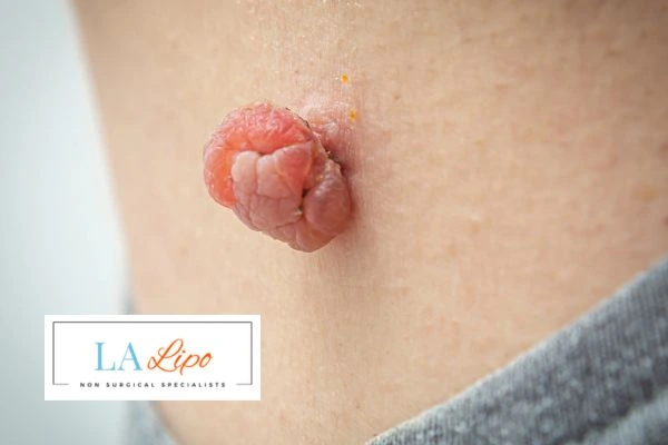 Interested in skin tag removal Eaton? Concerned about the pain? Find out more today!