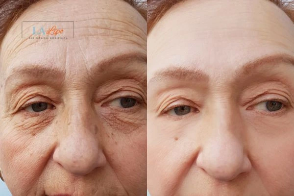 The powerful benefits of Morpheus8 Treatment Eaton - Call Our team today!