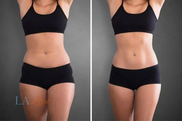 before and after results of non-surgical treatment to help a woman's body image and mental health Eaton