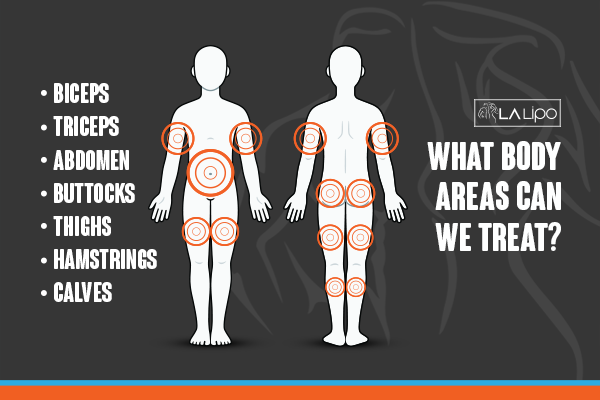 Diagram to show areas you can have LA-EMS Body Sculpting Treatment Eaton