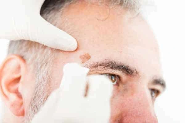 Age spots and elderly people Eaton what is the link?