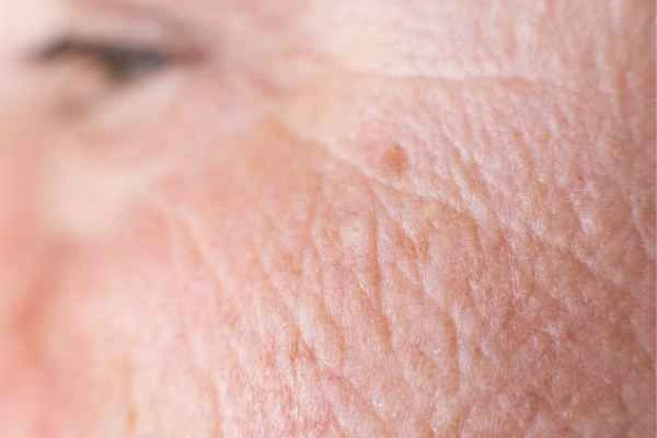close up picture of a woman's face showing an age spot Eaton