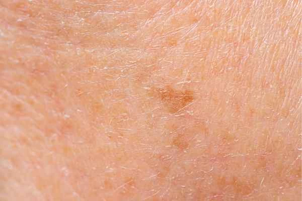 close up picture of age spots Eaton