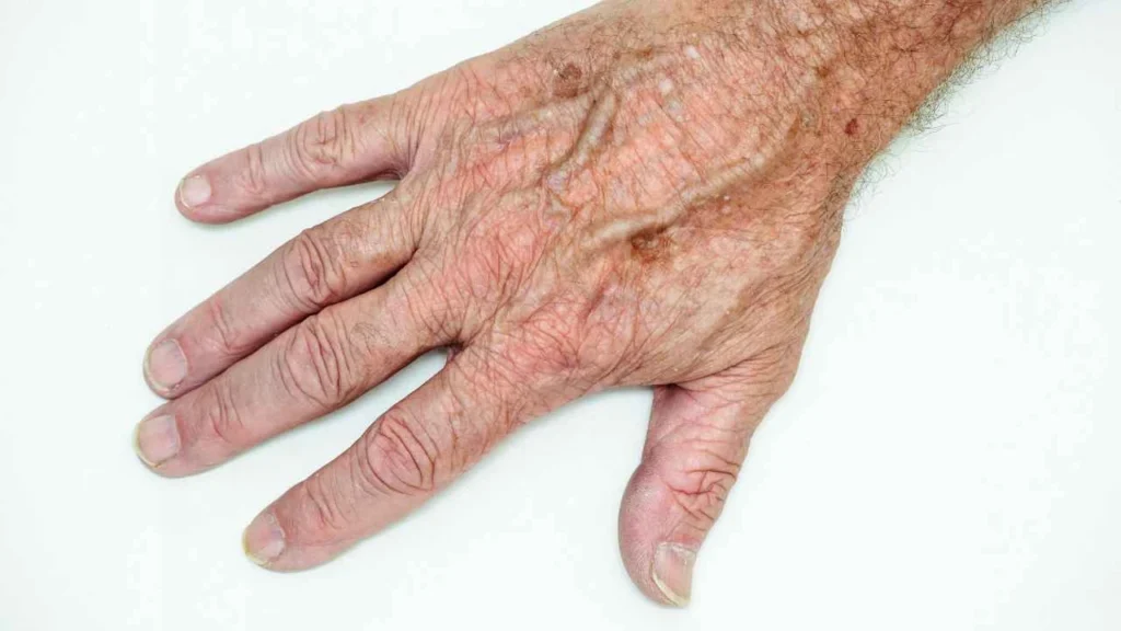 Male hand showing age spot Eaton