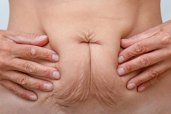 Should I Combine Diastasis Recti Treatment with Body Contouring for Better Results Eaton?