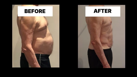 What Symptoms Can Diastasis Recti Cause in Men? Weak Core, Back Pain and Poor Posture Eaton